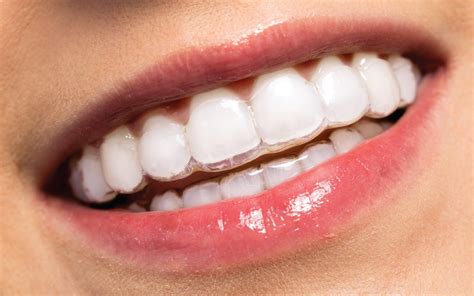 Transparante Invisalign.